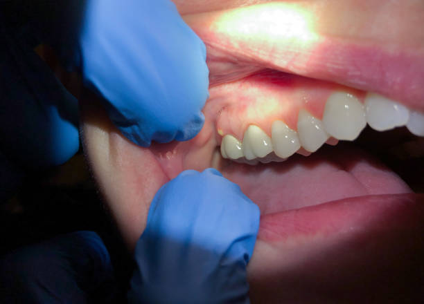 Best Emergency Dental Care for Abscessed Tooth in Hasbrouck Heights, NJ